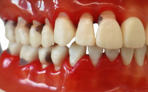 虫歯・知覚過敏など歯の痛み